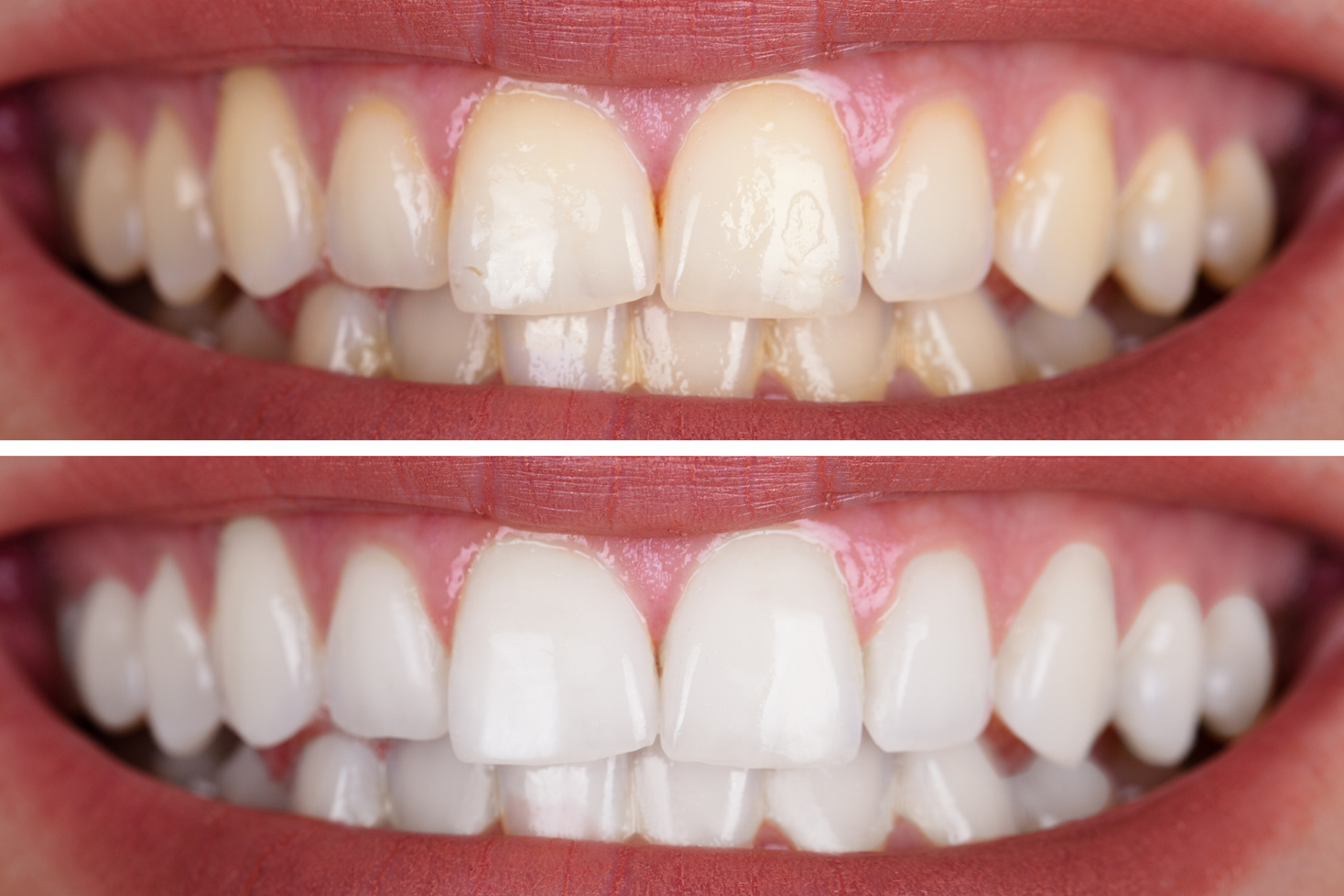 Antes e depois do clareamento dental