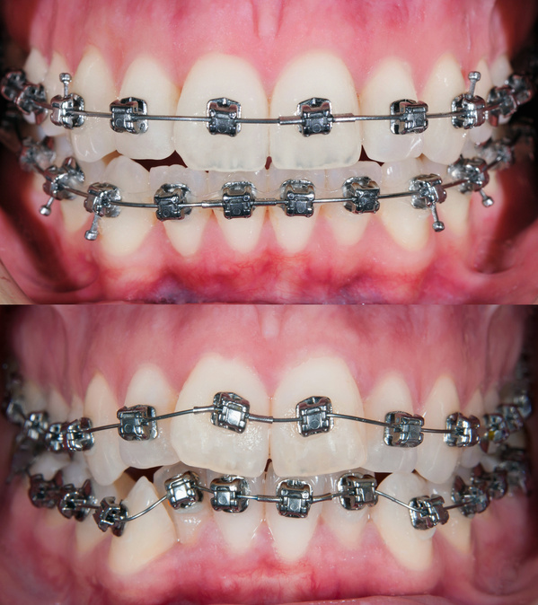 Antes e depois do tratamento ortodôntico