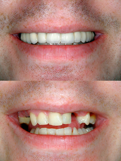 Antes e depois do Protocolo 72h