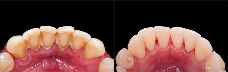 Antes e depois da limpeza dental profissional
