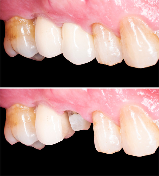 Antes e depois de coroa de porcelana