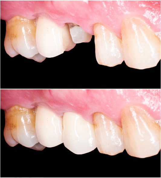 Antes e depois de coroa de porcelana