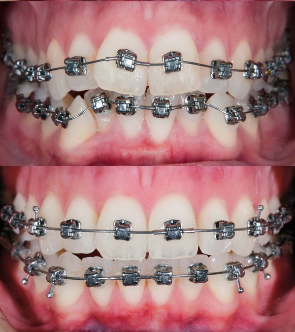 Antes e depois do tratamento ortodôntico